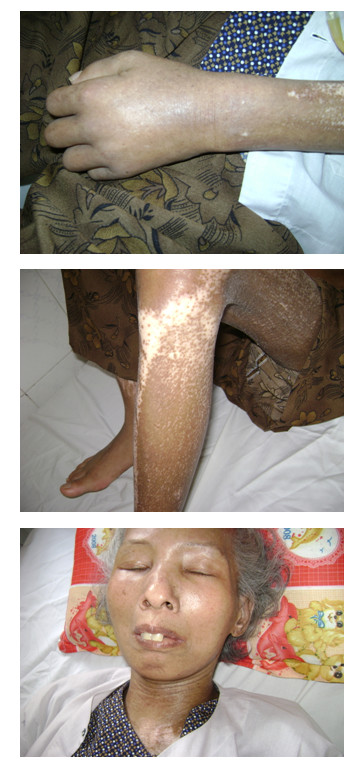 xơ cứng bì da