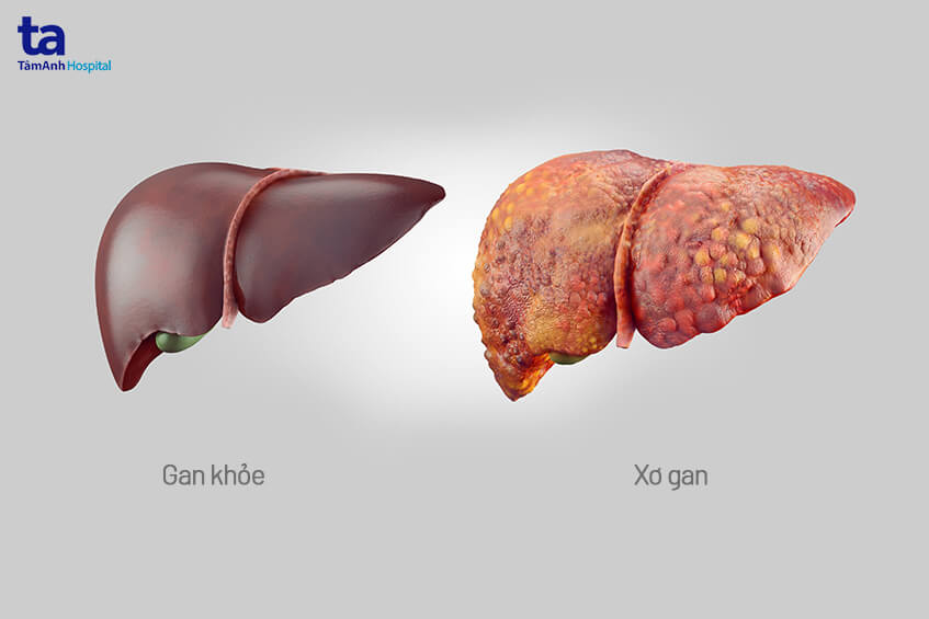 xơ gan - Image 2