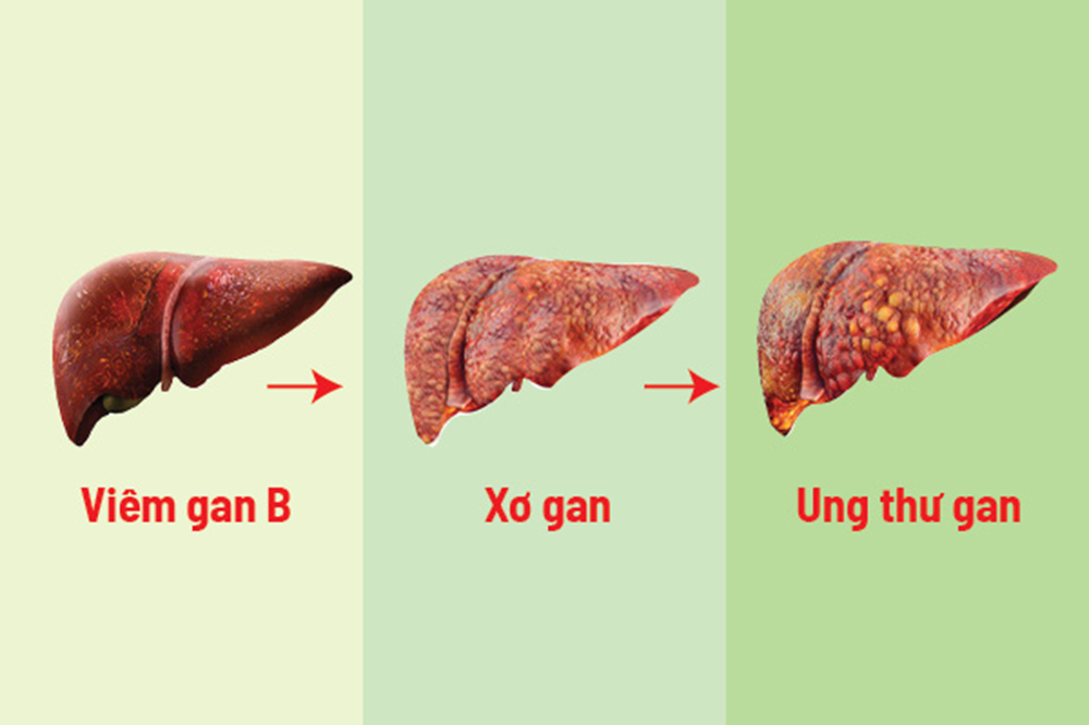 xơ gan - Image 3