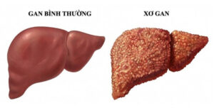 xơ gan