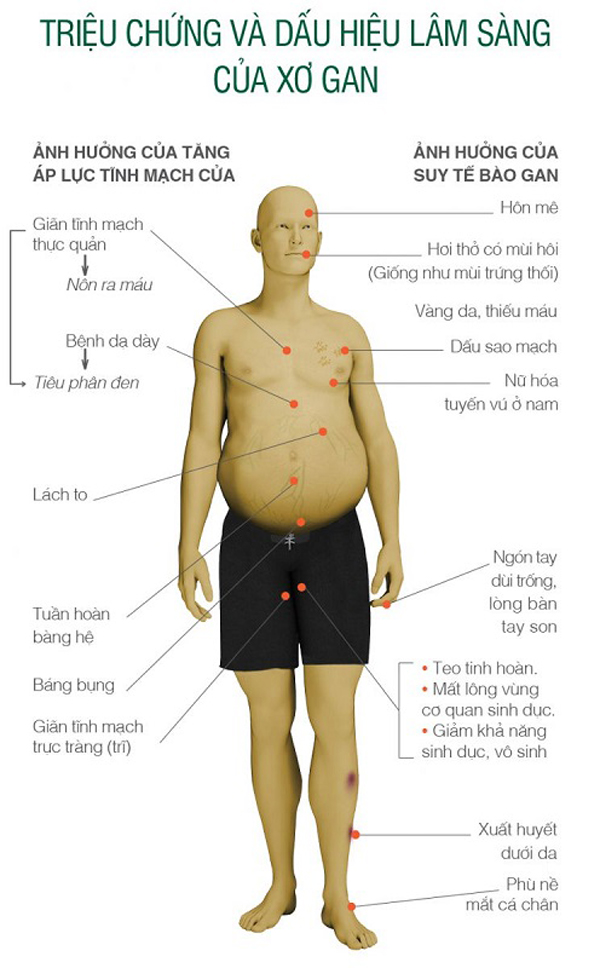 xơ gan - Image 5