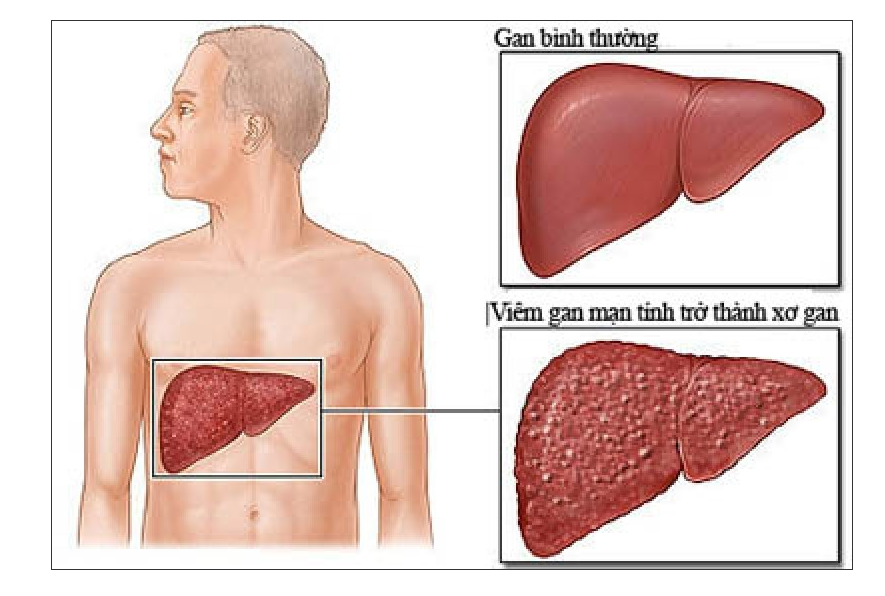 xơ gan có nguy hiểm không - Image 3