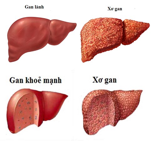 xơ gan có nguy hiểm không - Image 4