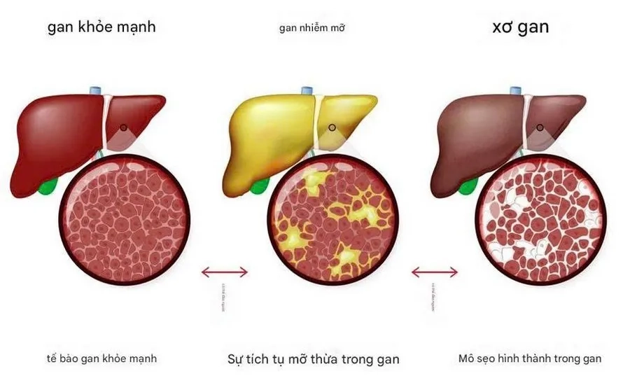 xơ gan do gan nhiễm mỡ - Image 2