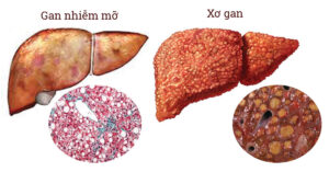 xơ gan do gan nhiễm mỡ
