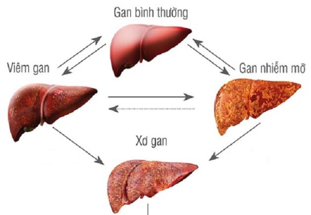 xơ gan do gan nhiễm mỡ - Image 3