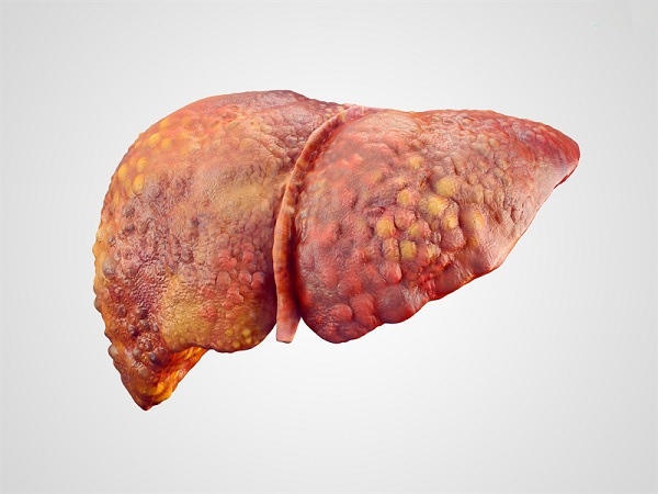 xơ gan do viêm gan B - Image 5