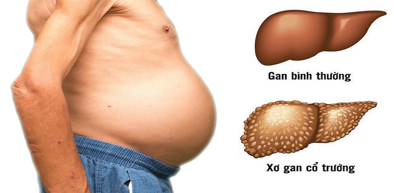 xơ gan kèm cổ trướng - Image 2