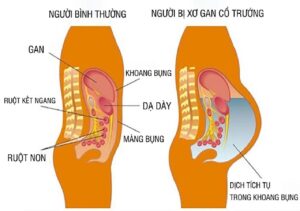 xơ gan kèm cổ trướng