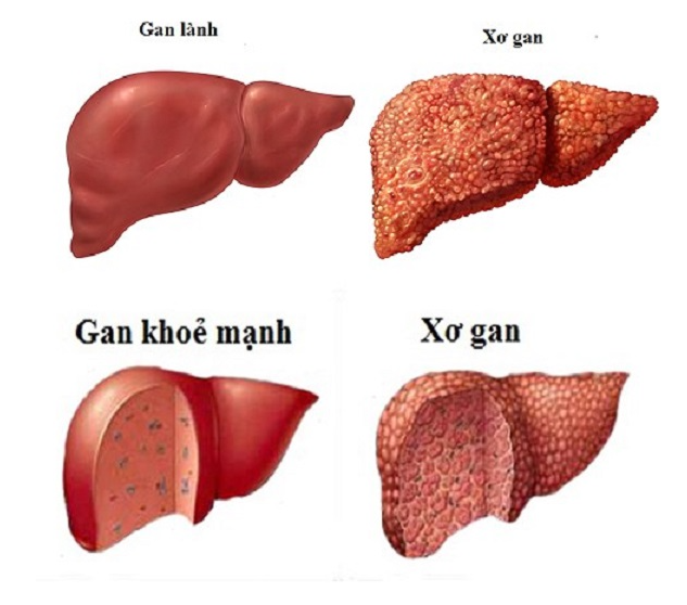 xơ gan kèm cổ trướng - Image 4