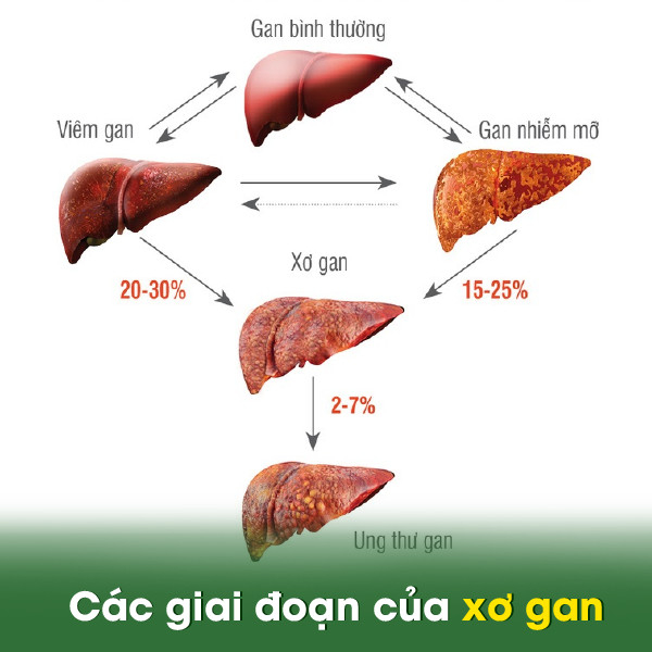 xơ gan là gì - Image 4