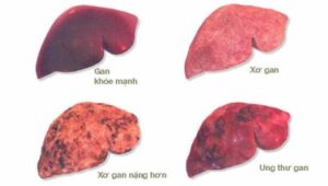 xơ gan ở người cao tuổi