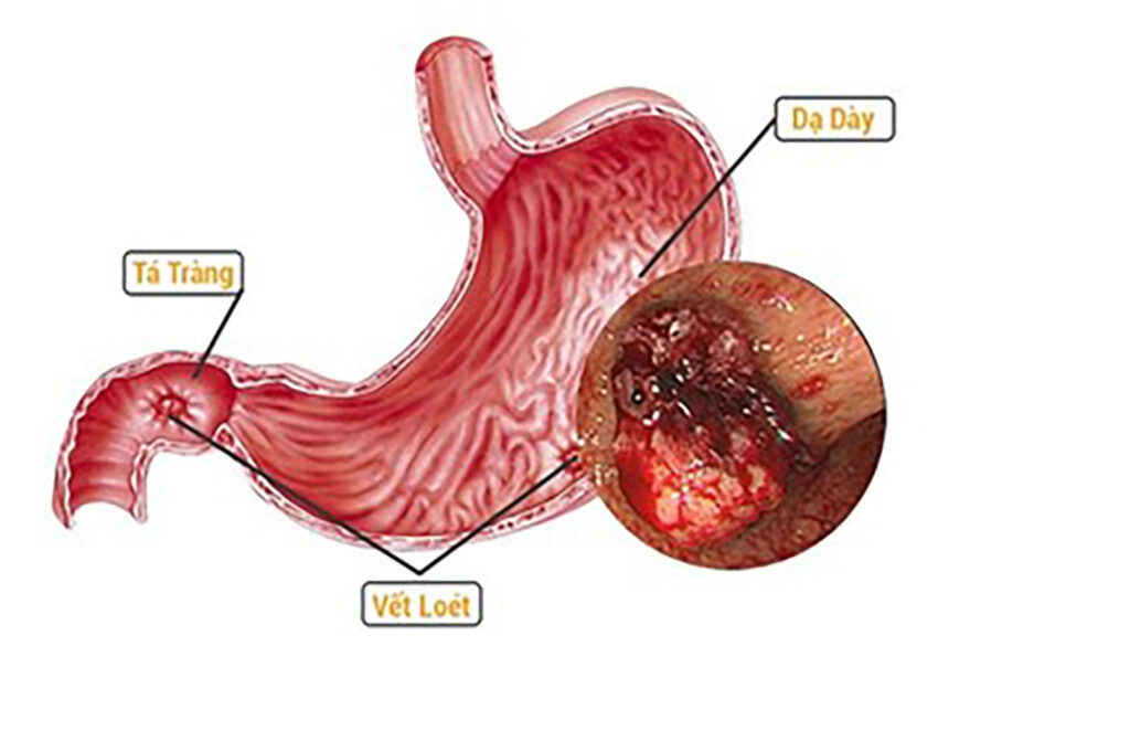 xuất huyết tiêu hóa ở người cao tuổi