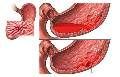 xuất huyết tiêu hóa ở người cao tuổi - Image 5