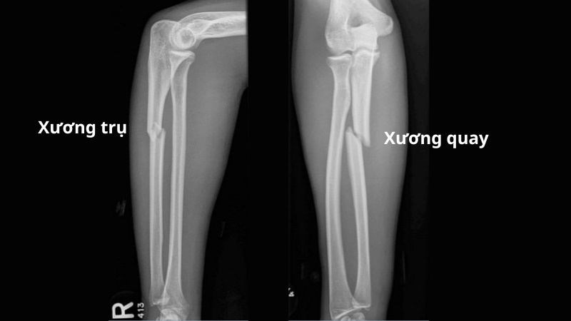 xương cẳng tay - Image 4