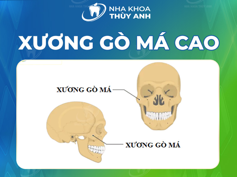 xương gò má - Image 5