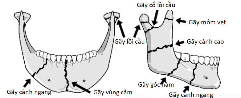 xương hàm dưới - Image 4