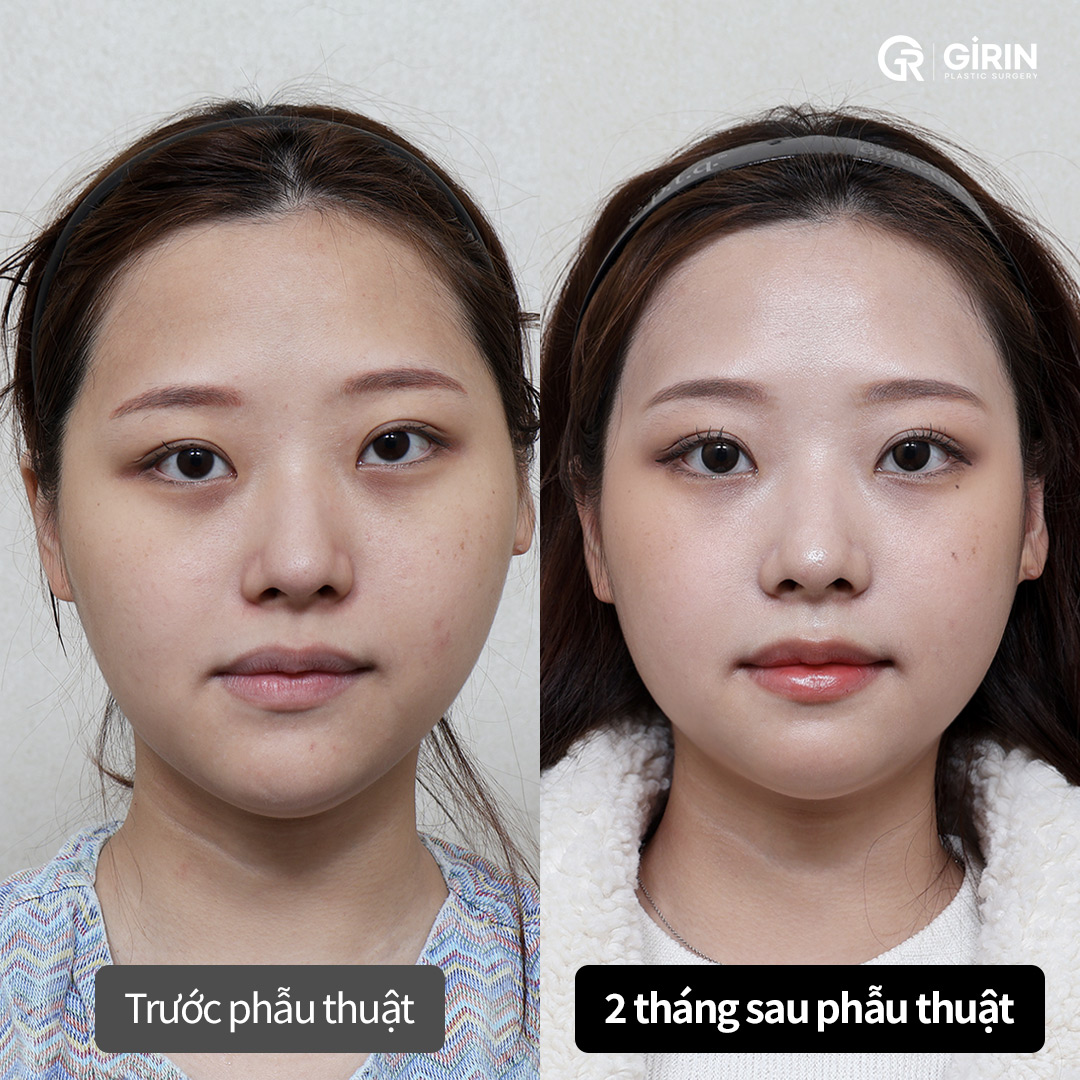xương mặt to - Image 2
