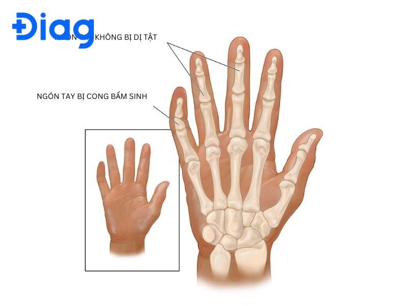 xương ngón tay bị cong