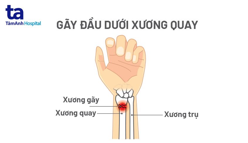 xương quay cổ tay - Image 4