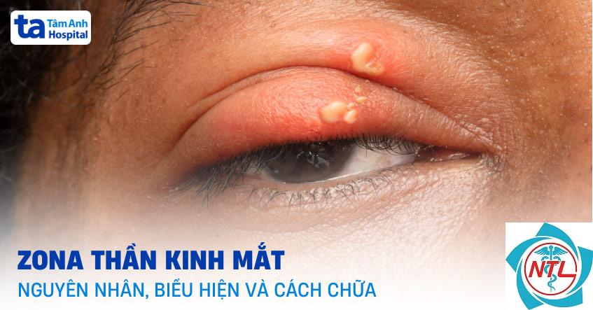 zona mắt - Image 4