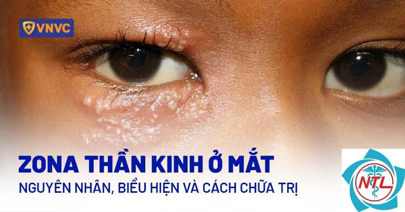 zona mắt - Image 5