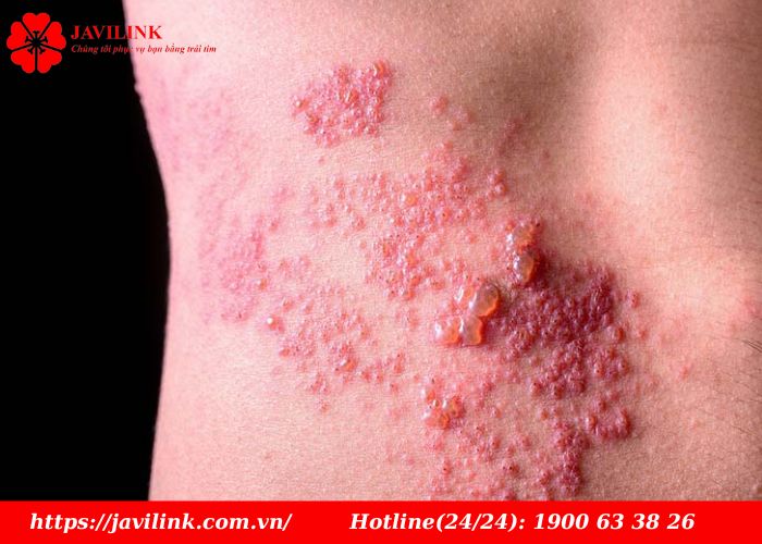 zona ở người cao tuổi