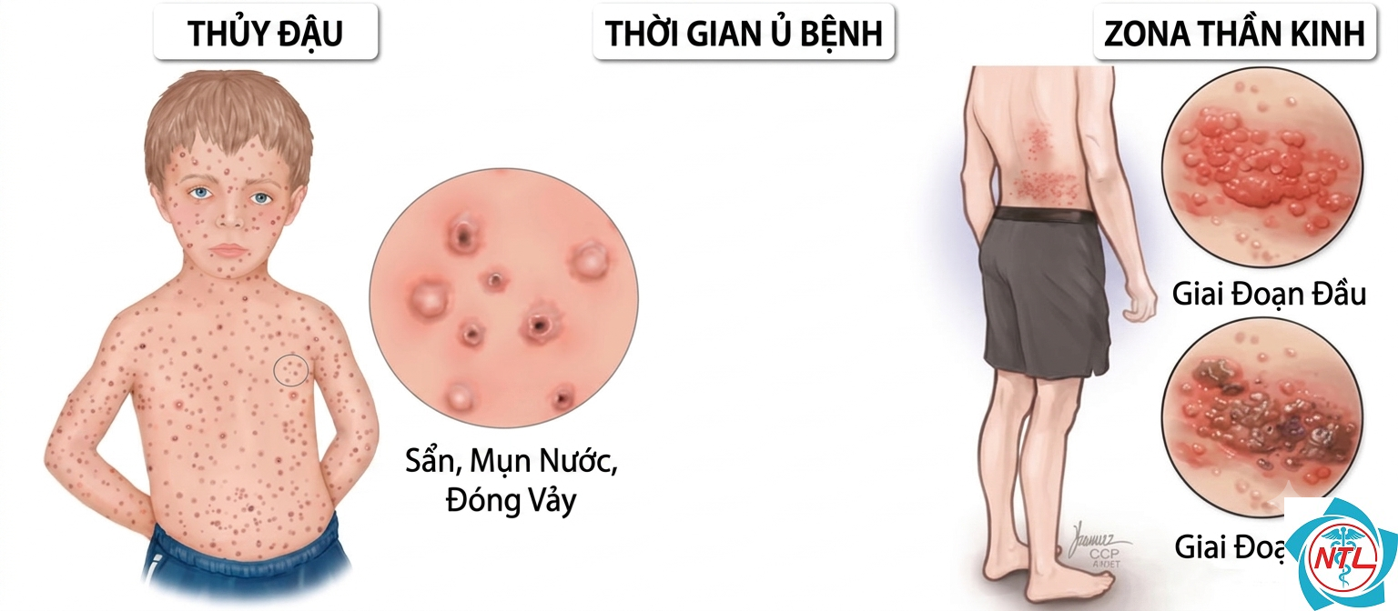 zona ở người suy giảm miễn dịch - Image 3
