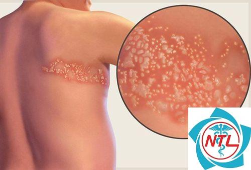 zona ở người suy giảm miễn dịch