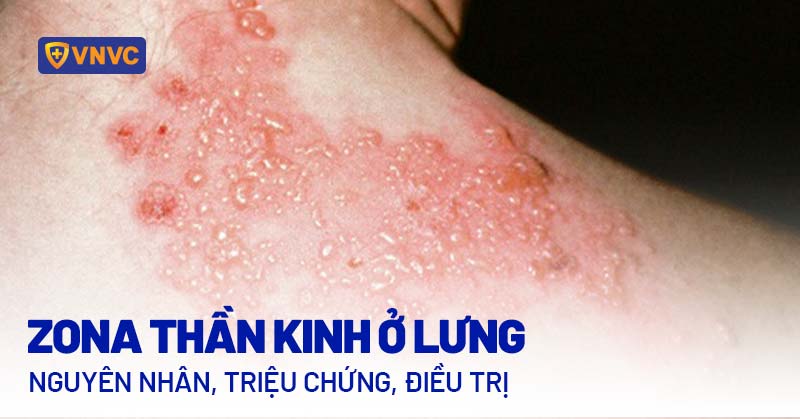zona thần kinh ở lưng - Image 2