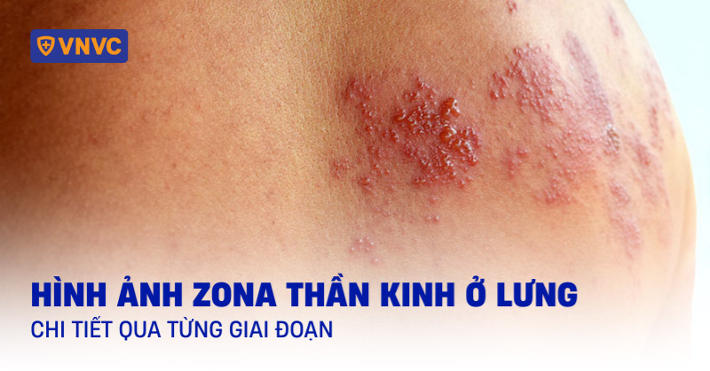 zona thần kinh ở lưng - Image 5
