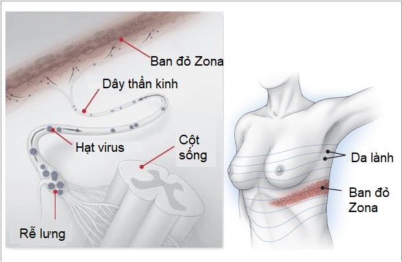 zona thần kinh ở ngực - Image 3