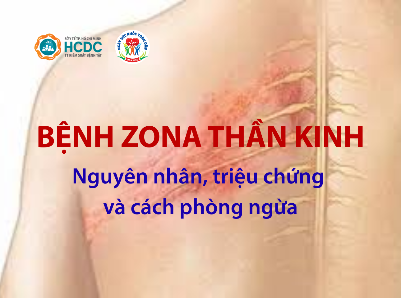 zona thần kinh ở người suy giảm miễn dịch - Image 3