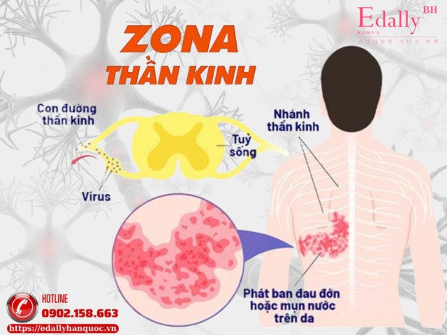 zona thần kinh ở người tiểu đường