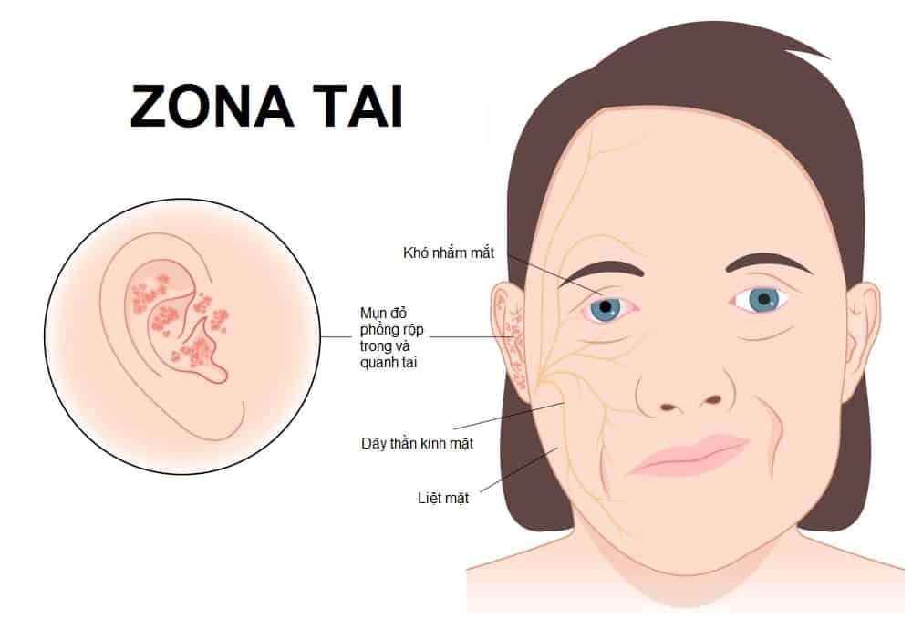 zona thần kinh ở tai - Image 3