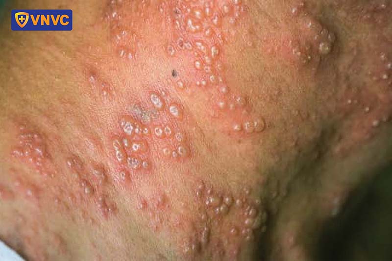 zona thần kinh tái phát