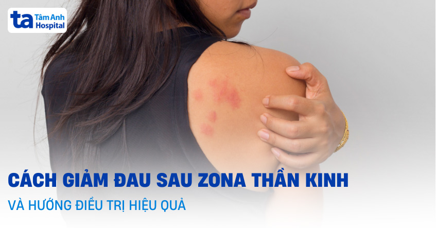 zona thần kinh và đau sau zona - Image 4