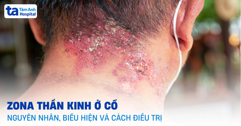zona thần kinh vùng cổ - Image 2