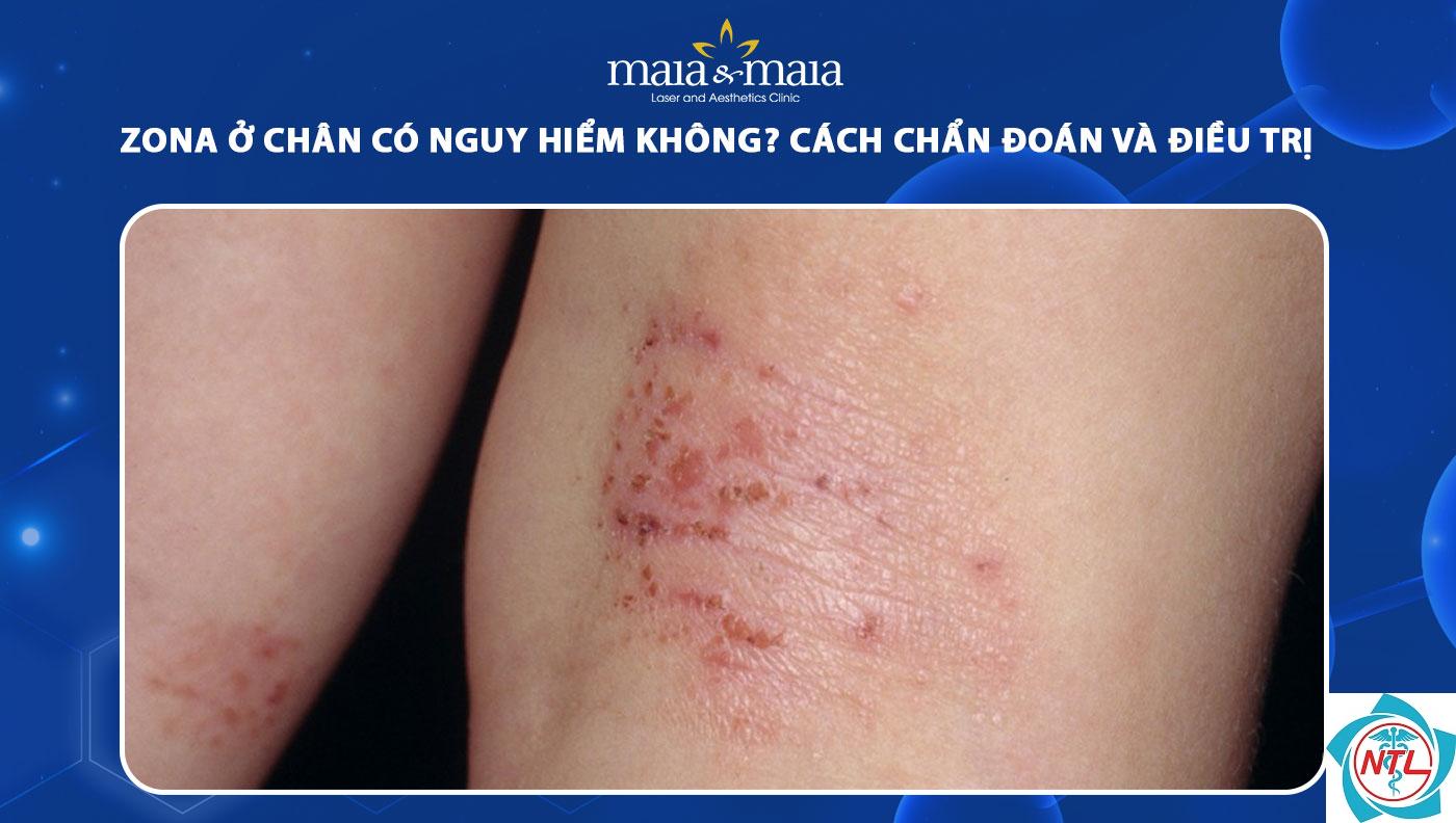 zona vùng chân - Image 2
