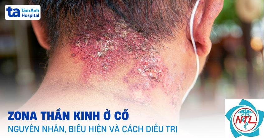 zona vùng cổ - Image 2