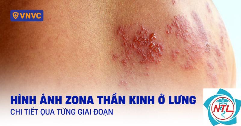zona vùng lưng - Image 4