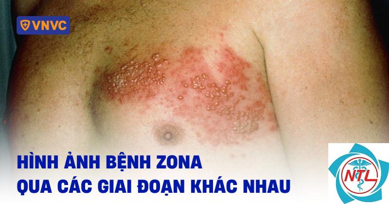 zona vùng ngực - Image 3