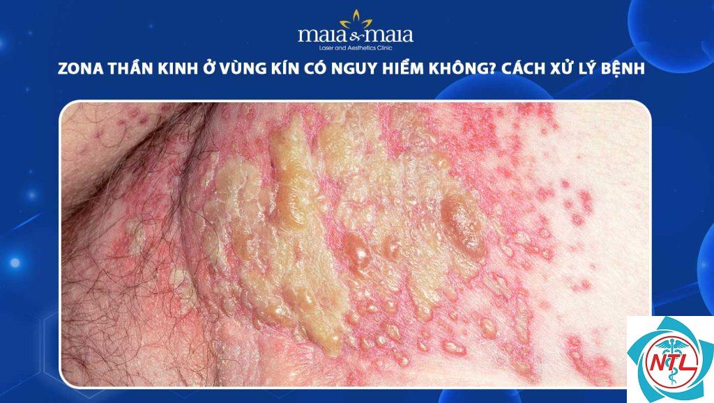 zona vùng sinh dục - Image 3
