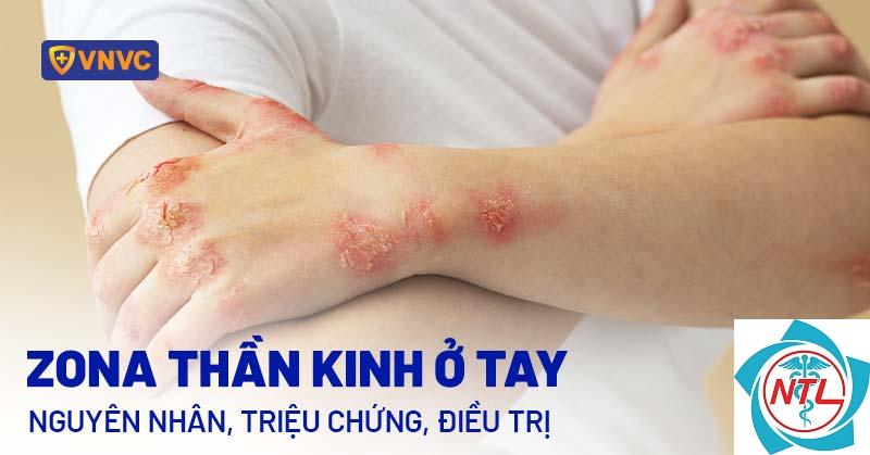 zona vùng tay