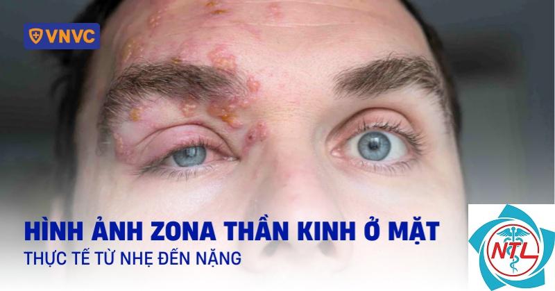 zona vùng trán - Image 5