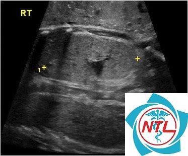 bệnh thận đa nang lặn nhiễm sắc thể thường