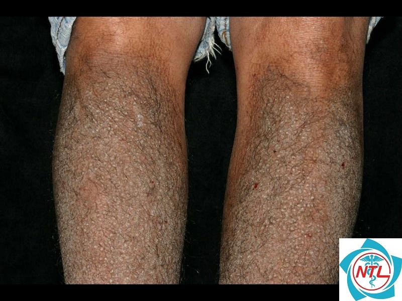 bệnh thận do amyloidosis - Image 3