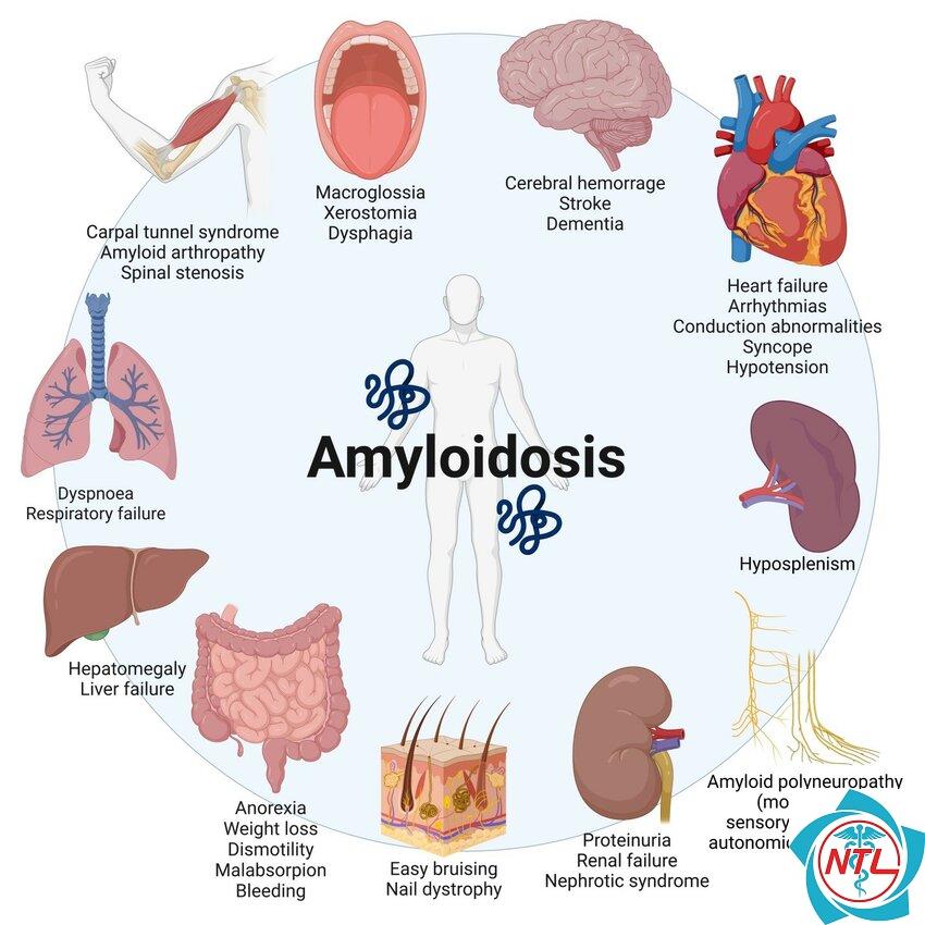 bệnh thận do amyloidosis - Image 5