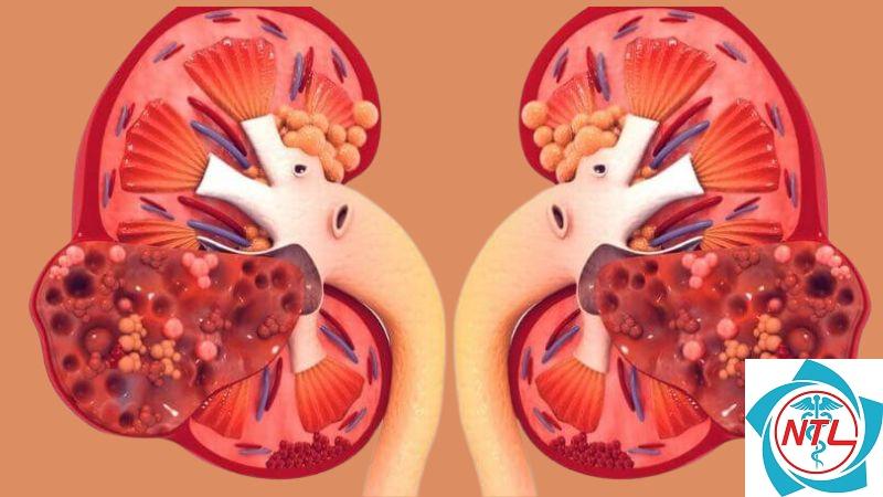 bệnh thận do amyloidosis