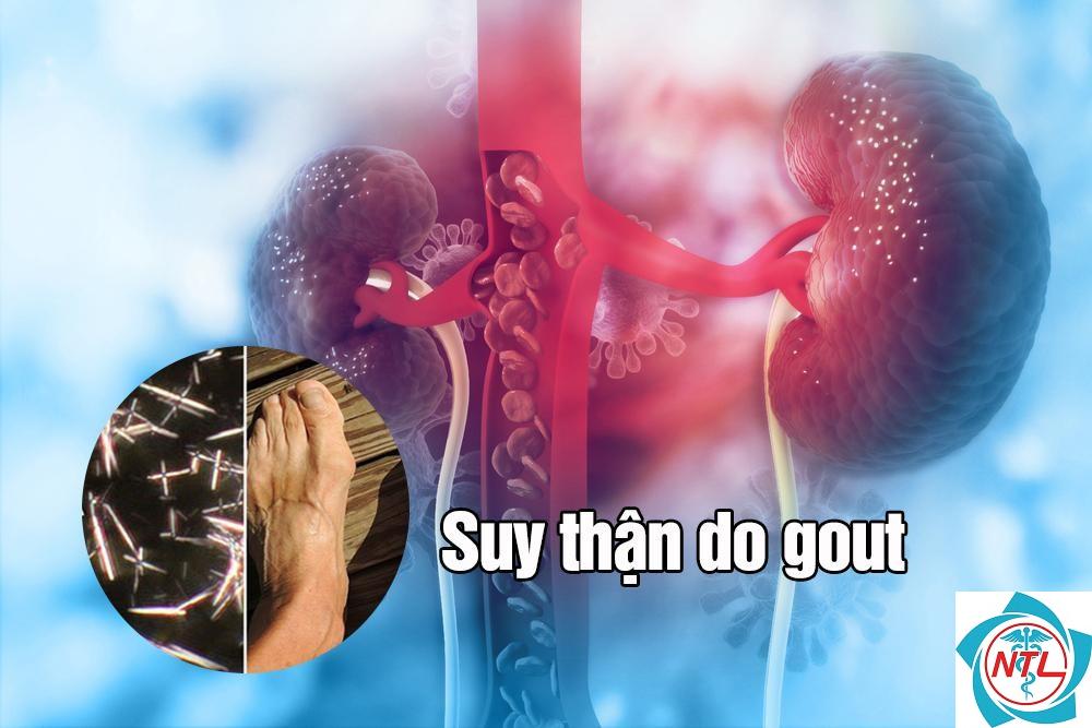 bệnh thận do axit uric